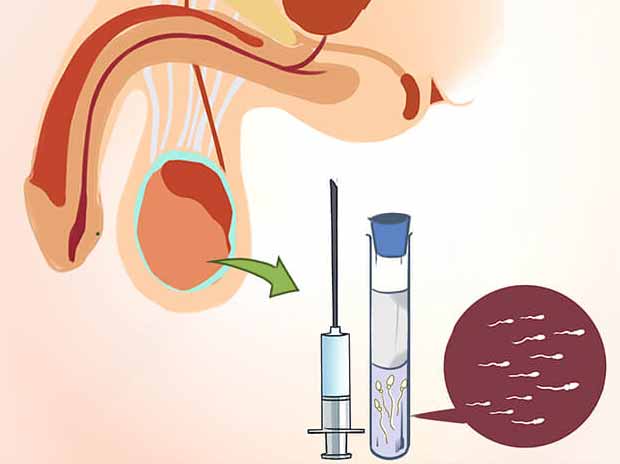 Surgical Sperm Retrieval