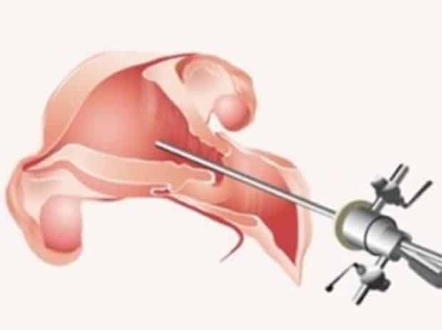 Endometrial scratch