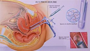 Infertility Specialists In Hyderabad