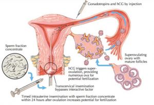 Infertility Doctors In Hyderabad