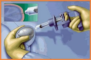 Infertility Doctors In Hyderabad