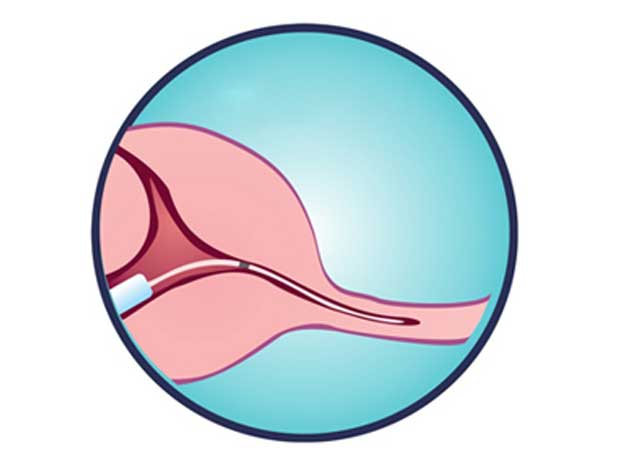 Fallopian Tube Cannulation